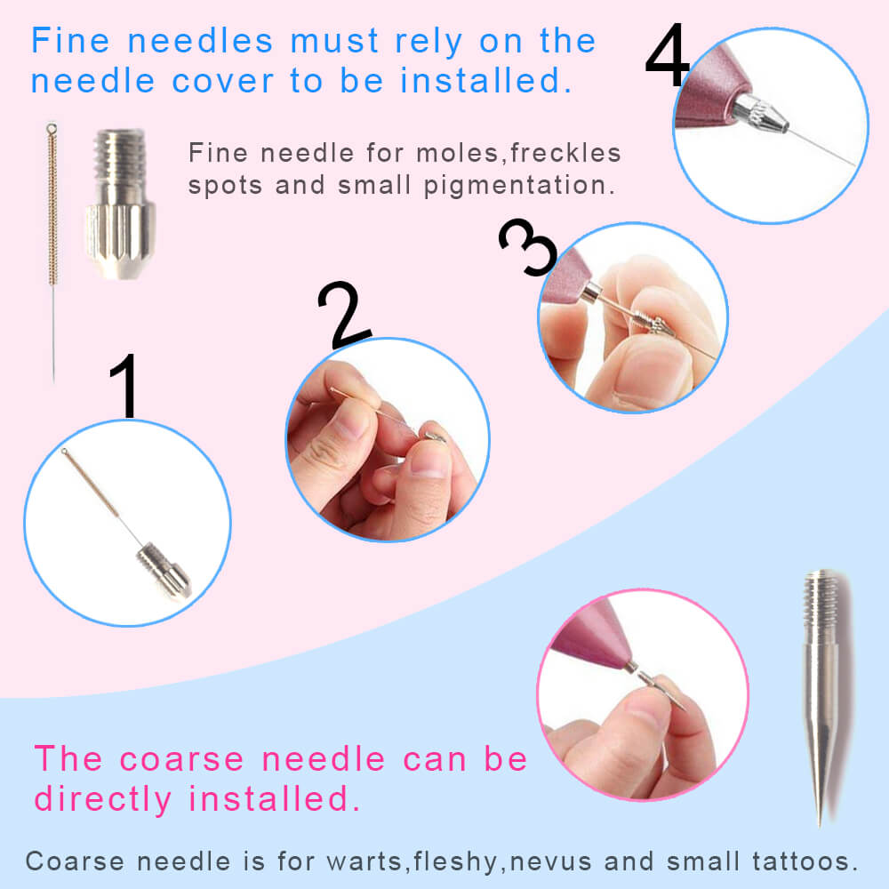 Laser Plasma Pen for Skin Tag Removal